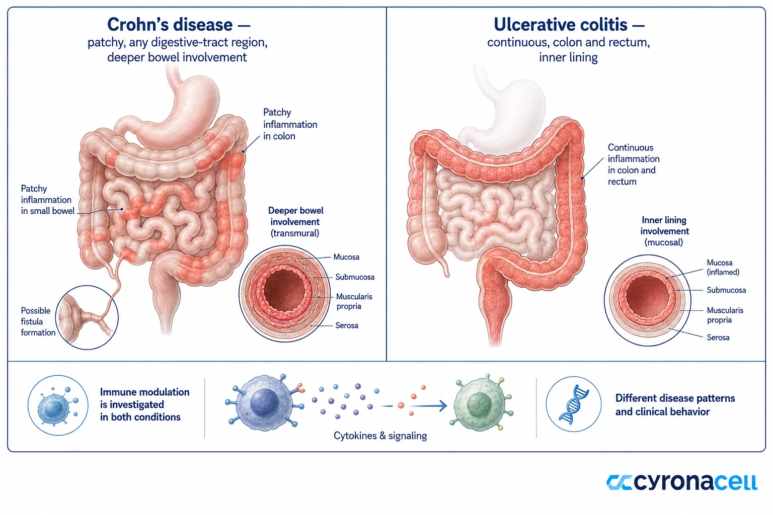 Stem Cell Therapy Alongside Ulcerative Colitis Care