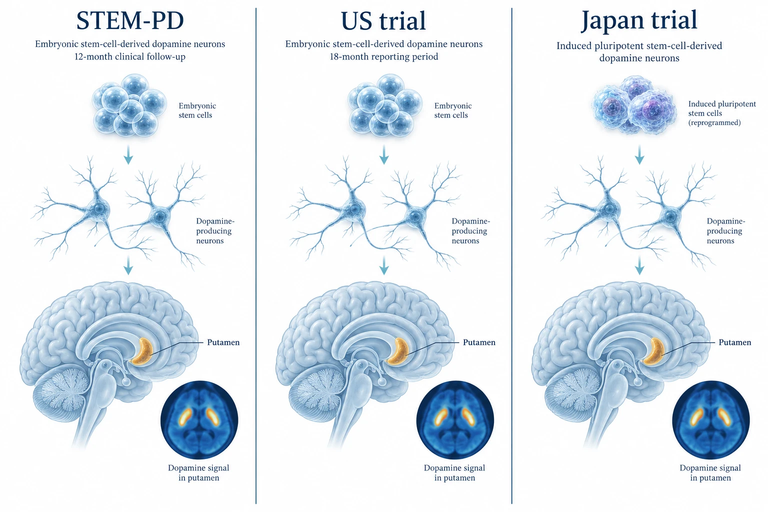 how-does-stem-pd-compare-with-other-stem-cell-trials-for-parkinson-s